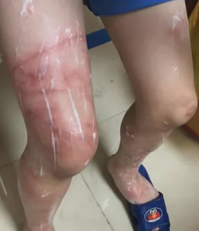 立即远离！外出遇到这种“塑料袋“别碰，有毒！有人伤口溃烂深可见脂肪…（组图） - 6