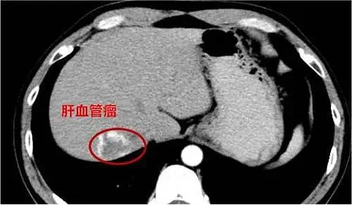 女生拿手电筒照手，网友发现不对劲！医生：这些危险信号要当心…（组图） - 7