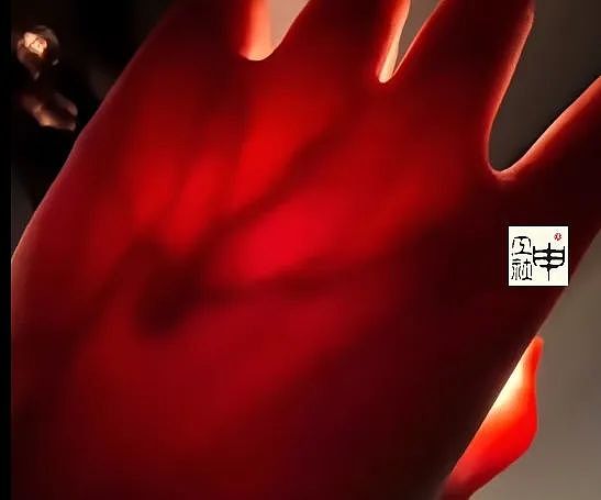 女生拿手电筒照手，网友发现不对劲！医生：这些危险信号要当心…（组图） - 2