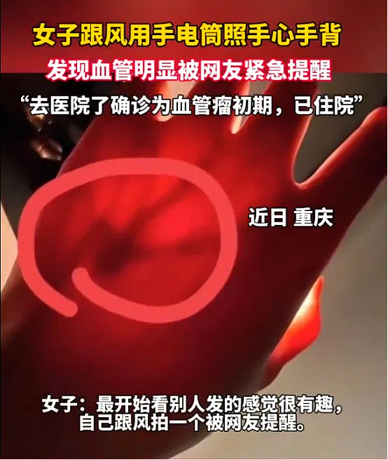 女生拿手电筒照手，网友发现不对劲！医生：这些危险信号要当心…（组图） - 4