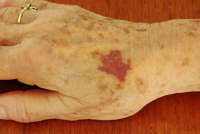 女生拿手电筒照手，网友发现不对劲！医生：这些危险信号要当心…（组图） - 8