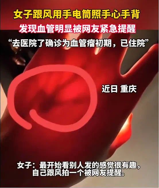 女生晒电筒照手图被网友发现不对劲！检查后确诊血管瘤立马住院手术，医生：这些危险信号要当心（组图） - 3