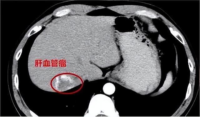 女生晒电筒照手图被网友发现不对劲！检查后确诊血管瘤立马住院手术，医生：这些危险信号要当心（组图） - 6