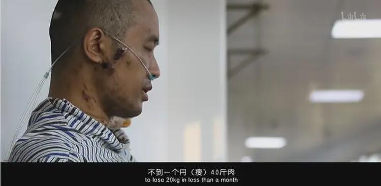 全身溃烂生不如死,丧失生育功能,武汉首批新冠患者如今结局如何(组图) - 15