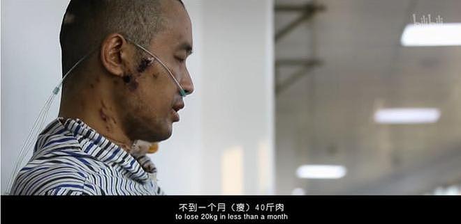 全身溃烂生不如死，丧失生育功能，武汉首批新冠患者如今结局如何（组图） - 15