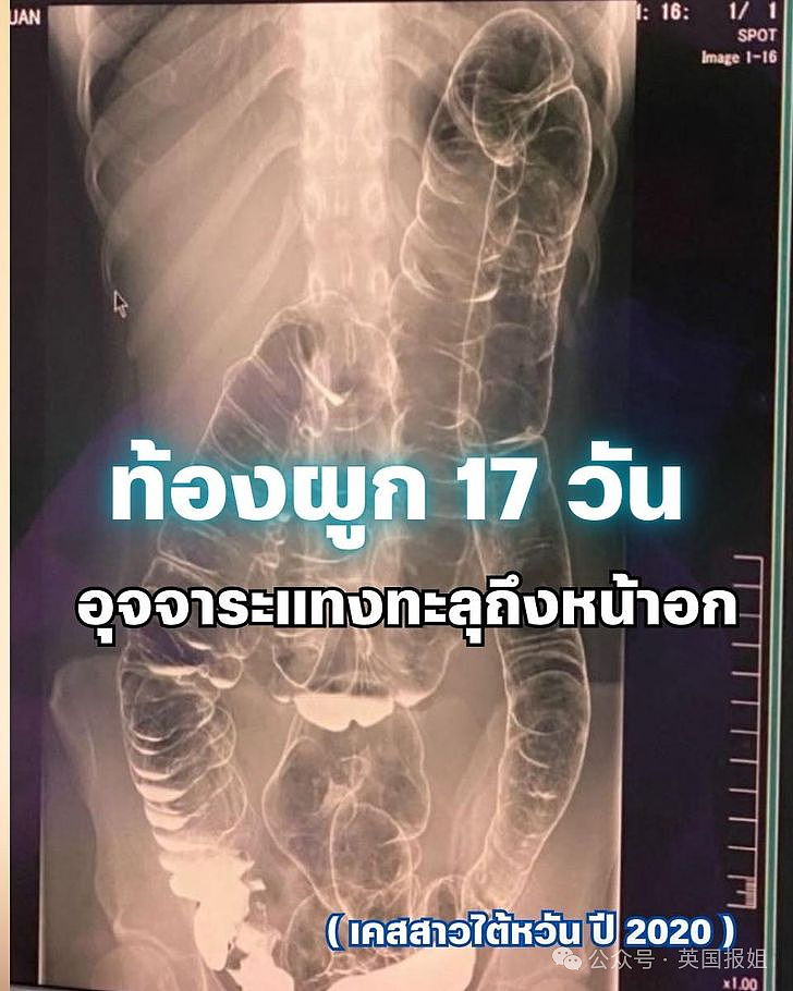 华女便秘多日竟憋到吐屎？X光显示塞满胸腔，众多网友分享痛苦蹲坑经历！（组图） - 3