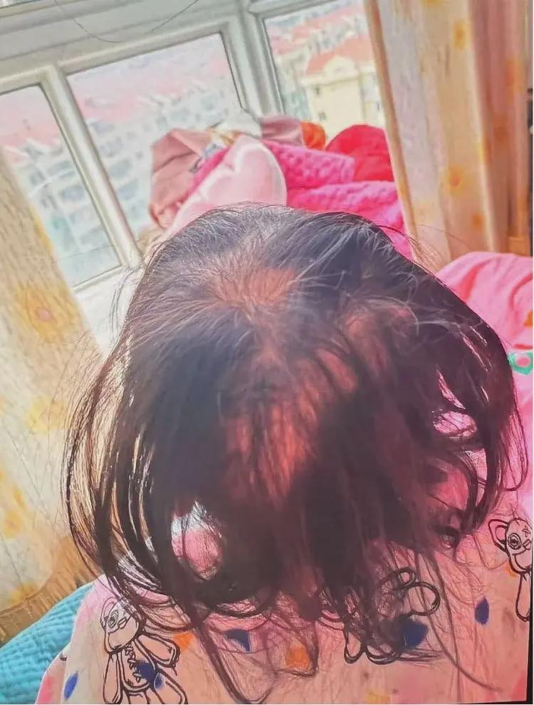 3岁女孩铊中毒，医院回应：警方确定是人为投毒（组图） - 1
