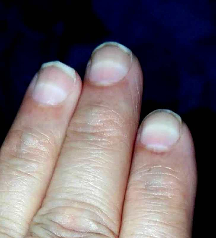 比砒霜还毒！3岁女童大把脱发、走路如踩棉花，查出急性铊中毒（视频/组图） - 2