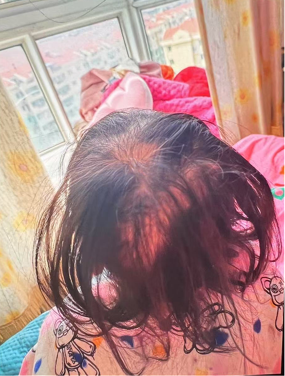 比砒霜还毒！3岁女童大把脱发、走路如踩棉花，查出急性铊中毒（视频/组图） - 1