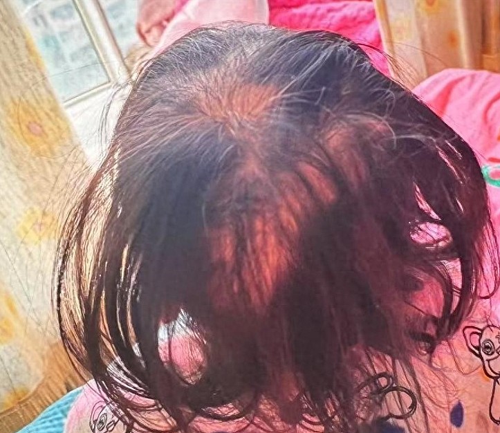 中国三岁女童铊中毒,据报因家庭纠纷被人为投毒(图) - 1