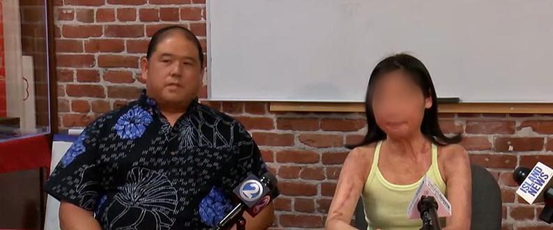 华女险命丧街头！被硫酸从头泼到脚，1年做6次手术还没完！肺部塌陷，身上全是伤疤（组图） - 6