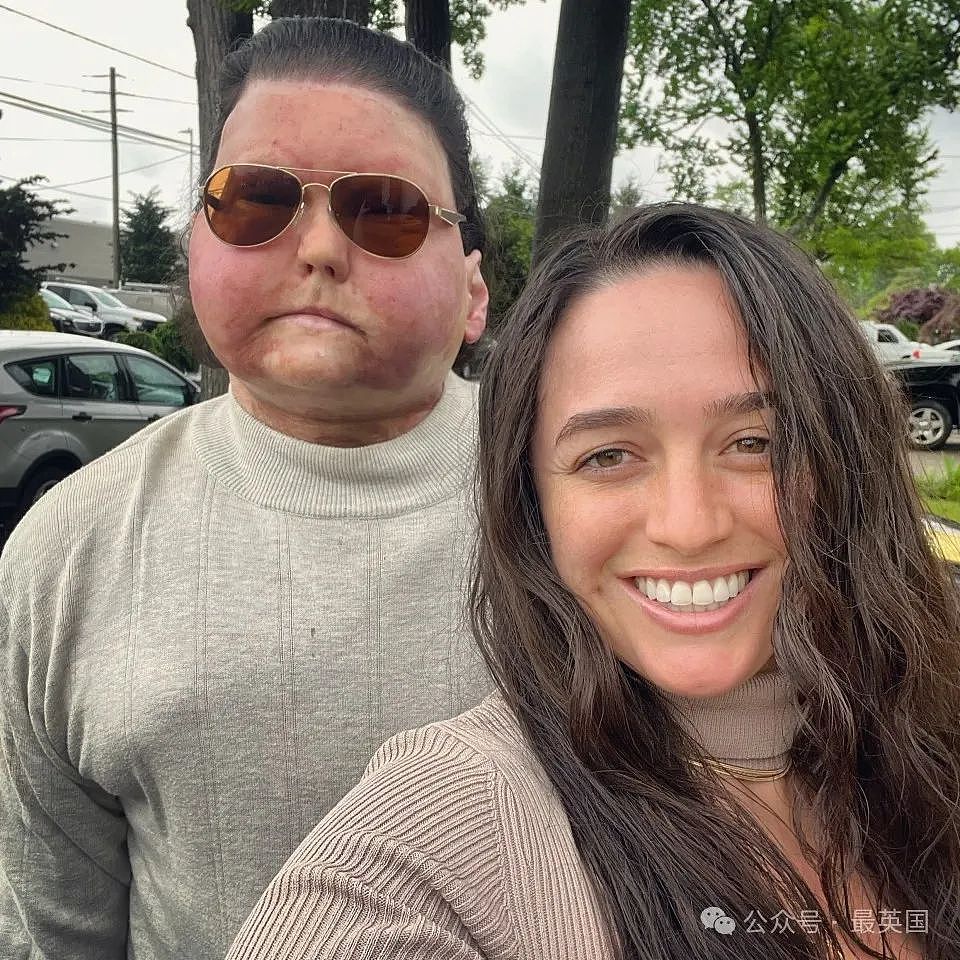帅哥彻底毁容，脸被烧没了，你还会爱吗？全球首例“换脸换手”男子迎娶真爱，网友炸锅（组图） - 10