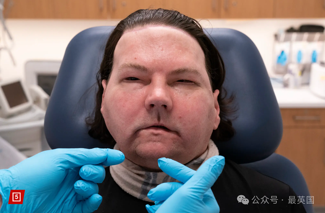 帅哥彻底毁容，脸被烧没了，你还会爱吗？全球首例“换脸换手”男子迎娶真爱，网友炸锅（组图） - 7
