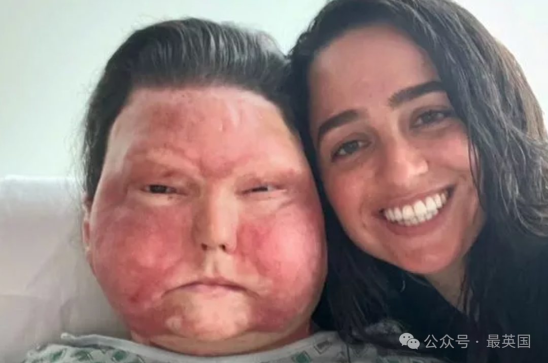 帅哥彻底毁容，脸被烧没了，你还会爱吗？全球首例“换脸换手”男子迎娶真爱，网友炸锅（组图） - 21