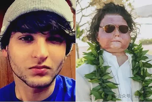 帅哥彻底毁容，脸被烧没了，你还会爱吗？全球首例“换脸换手”男子迎娶真爱，网友炸锅（组图） - 3