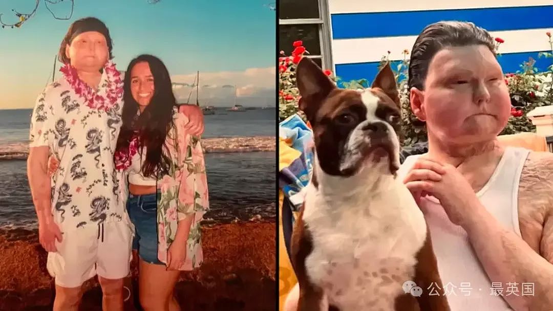 帅哥彻底毁容，脸被烧没了，你还会爱吗？全球首例“换脸换手”男子迎娶真爱，网友炸锅（组图） - 14