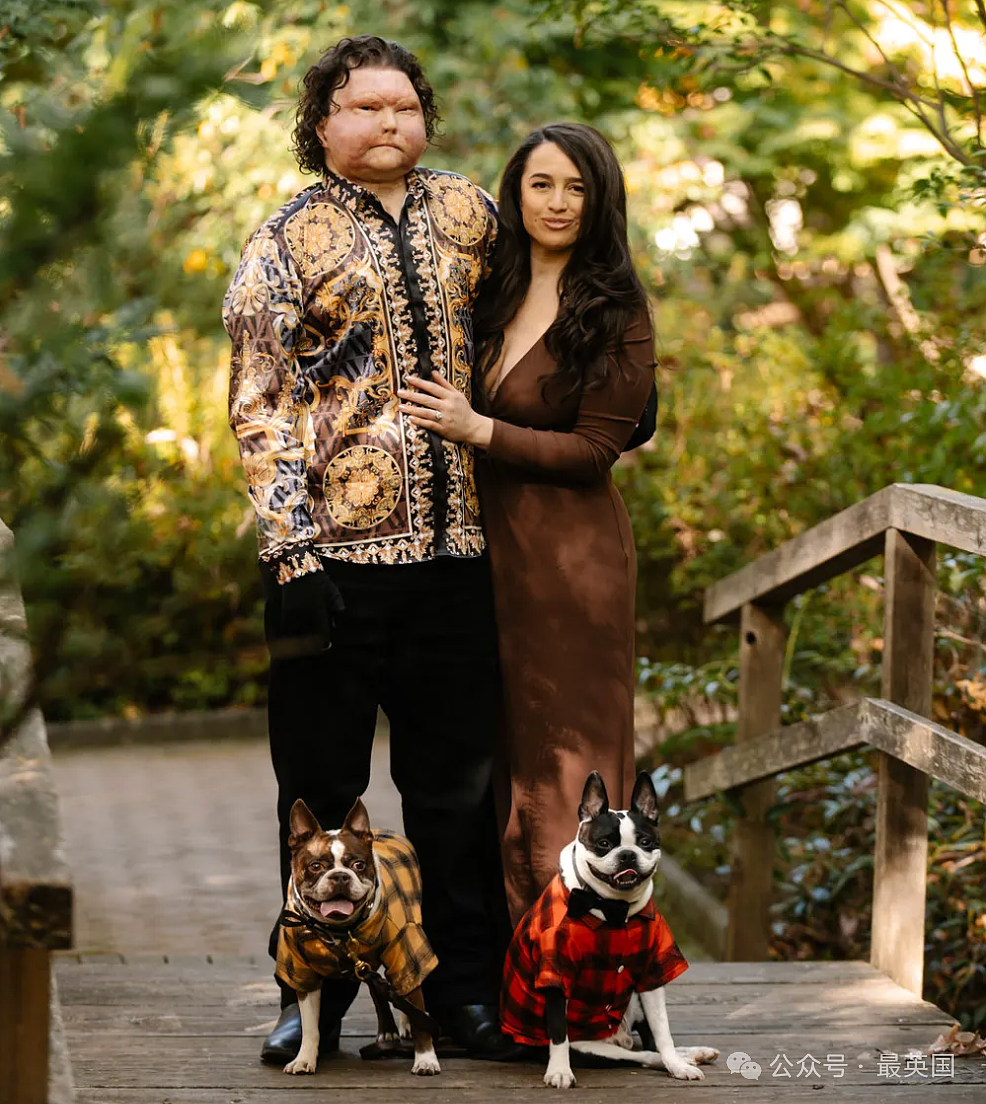 帅哥彻底毁容，脸被烧没了，你还会爱吗？全球首例“换脸换手”男子迎娶真爱，网友炸锅（组图） - 2