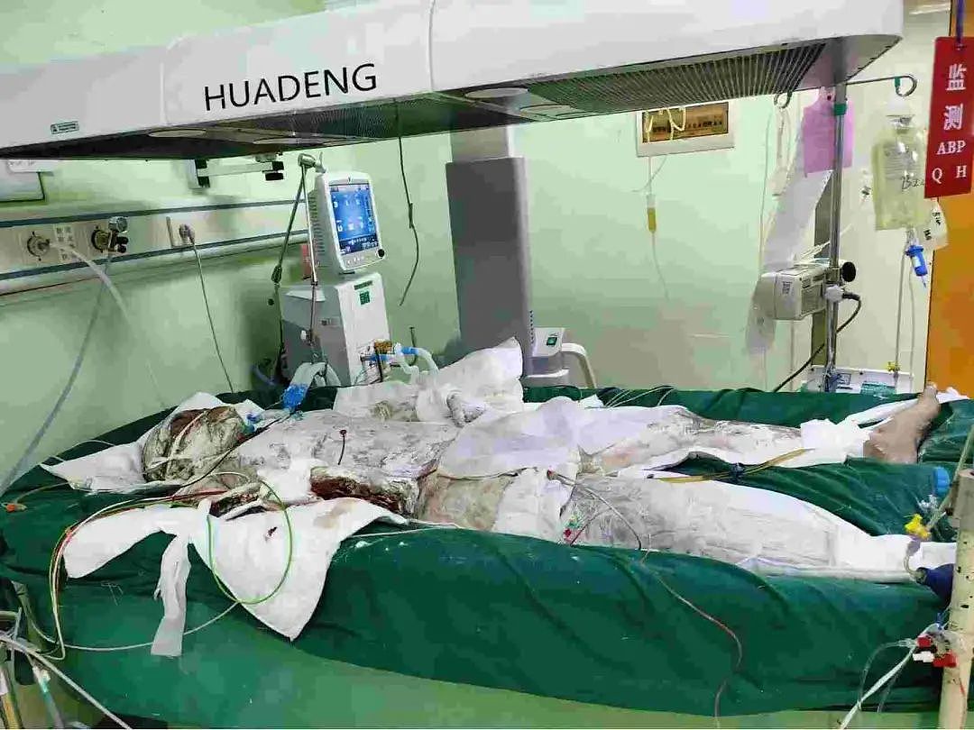 武汉某大学,室友冲电瓶车爆炸,21岁男生全身90%面积烧伤,跌进绝望深渊(组图) - 1