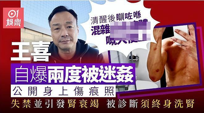 港星王喜自曝被两度侵犯后患肾衰竭,熟人作案没报警,需终身洗肾(组图) - 1