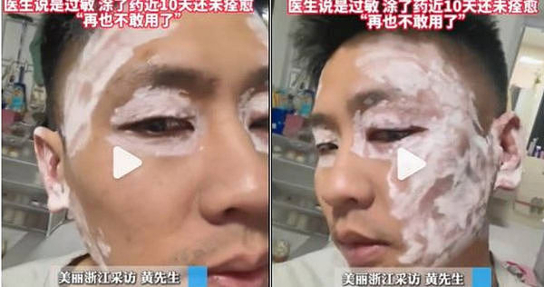 中国男子用“纸巾擦脸”险毁容！回家照镜吓傻：“肿成猪脸”（视频/图） - 1