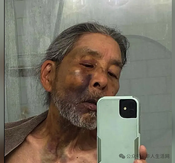 讽刺!71岁教授讲了一辈子“种族歧视”,却被暴力撞伤怒骂:滚回你的国家(组图) - 2