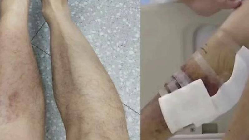 深圳男子暴雨中蹚水后感染丹毒！发烧至40℃，腿部红肿疼痛险酿祸（组图） - 1