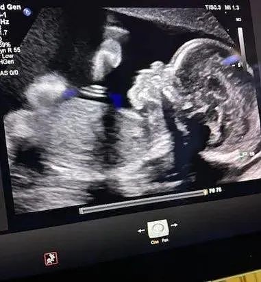 孕妇脑死亡，但法律禁止堕胎，就逼她以活死人状态继续怀孕！钱还她出？（组图） - 3