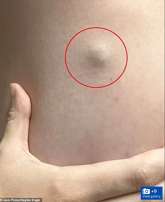 崩溃！22岁妹子身上长“包”，一查癌症4期！全身疯长45个肿瘤，小心这些症状（组图） - 2
