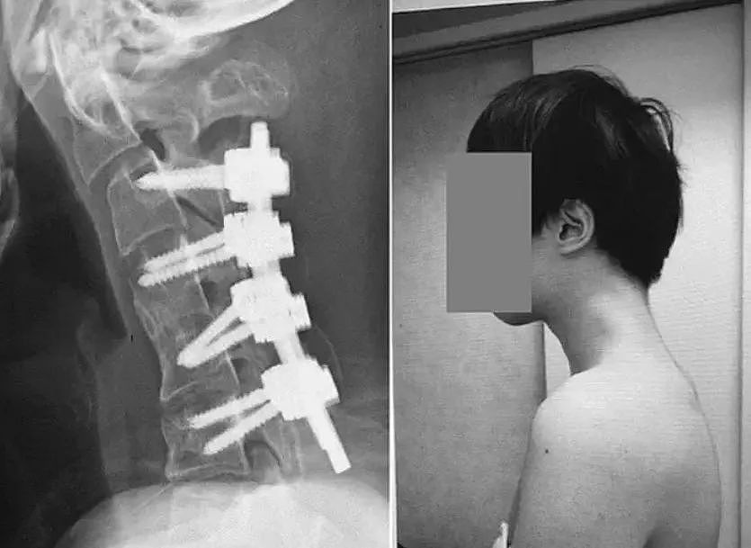 年轻男子无无法抬头，骨头近乎刺穿皮肤，竟是玩手机玩的？（组图） - 6