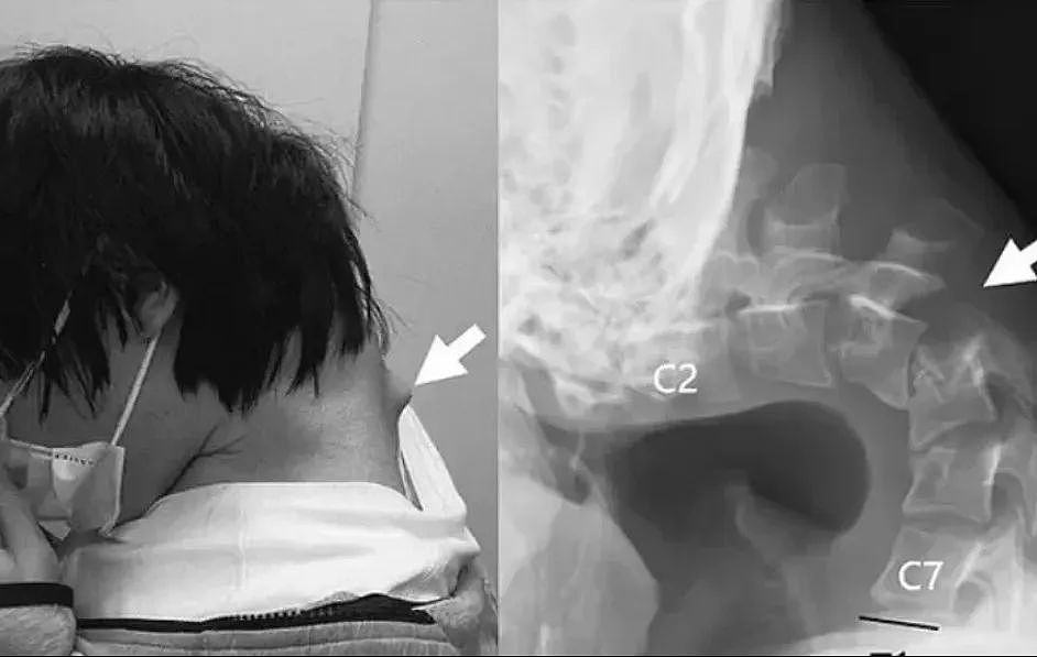年轻男子无无法抬头，骨头近乎刺穿皮肤，竟是玩手机玩的？（组图） - 3