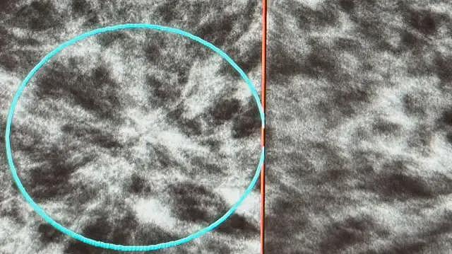 原型扫描仪:新诊断技术如何“照亮”隐藏的乳癌(组图) - 4