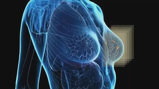 原型扫描仪:新诊断技术如何“照亮”隐藏的乳癌(组图) - 1