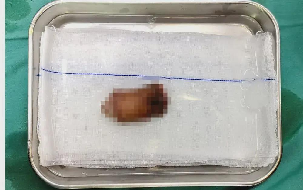 阴茎遭切割机完全离断,这家医院帮他接回去了(组图) - 2