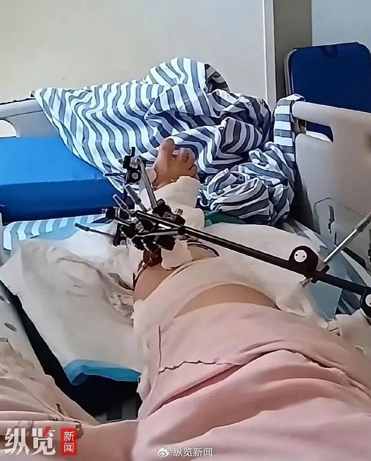 44岁女子不慎从12楼堕地，竟奇迹生还！这一物成“救命神器”（组图） - 2