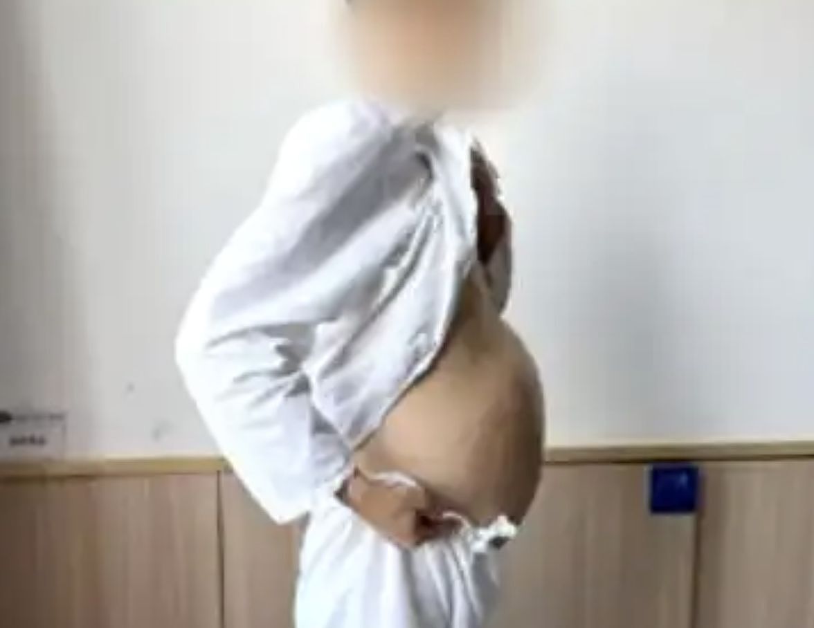 中国男子便秘4个月“腹肿如怀孕”！医生掏出2公尺坏死“屎前巨蟒”（组图） - 1