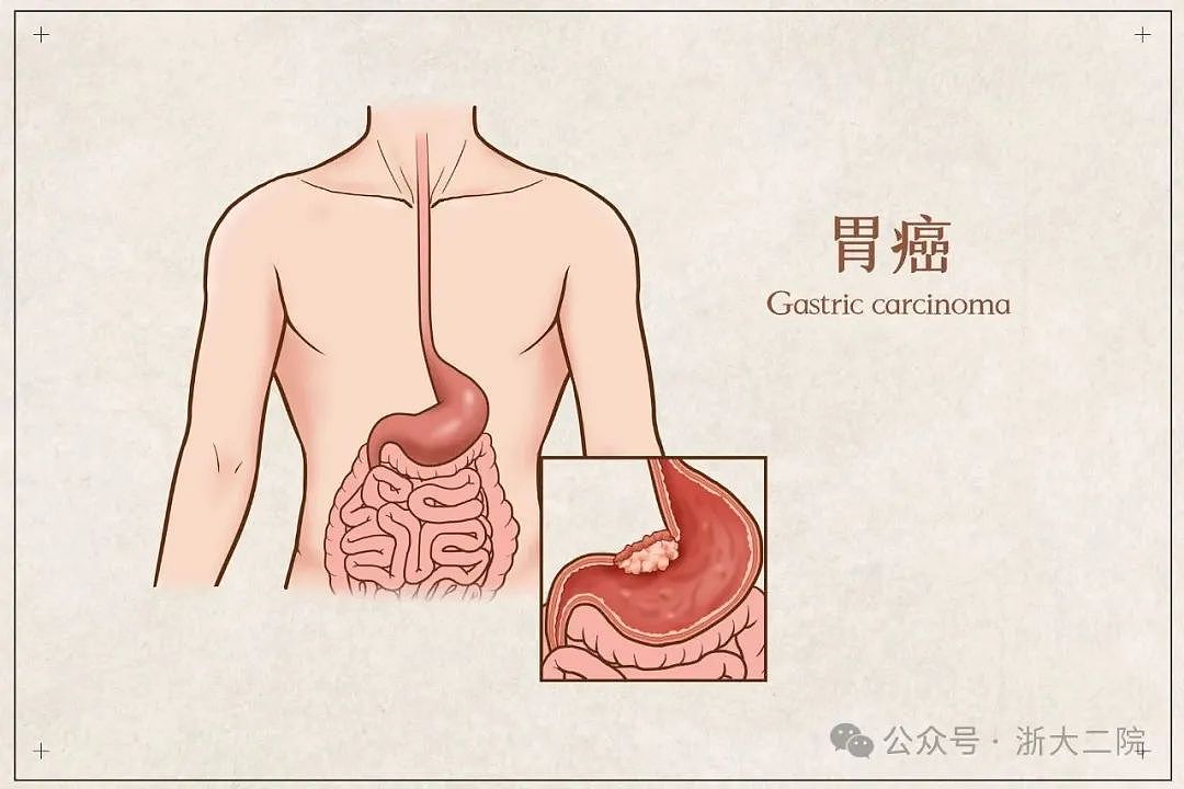 男子胃口变差，吃了就想吐，查出即晚期！这种癌要靠这样发现（组图） - 4