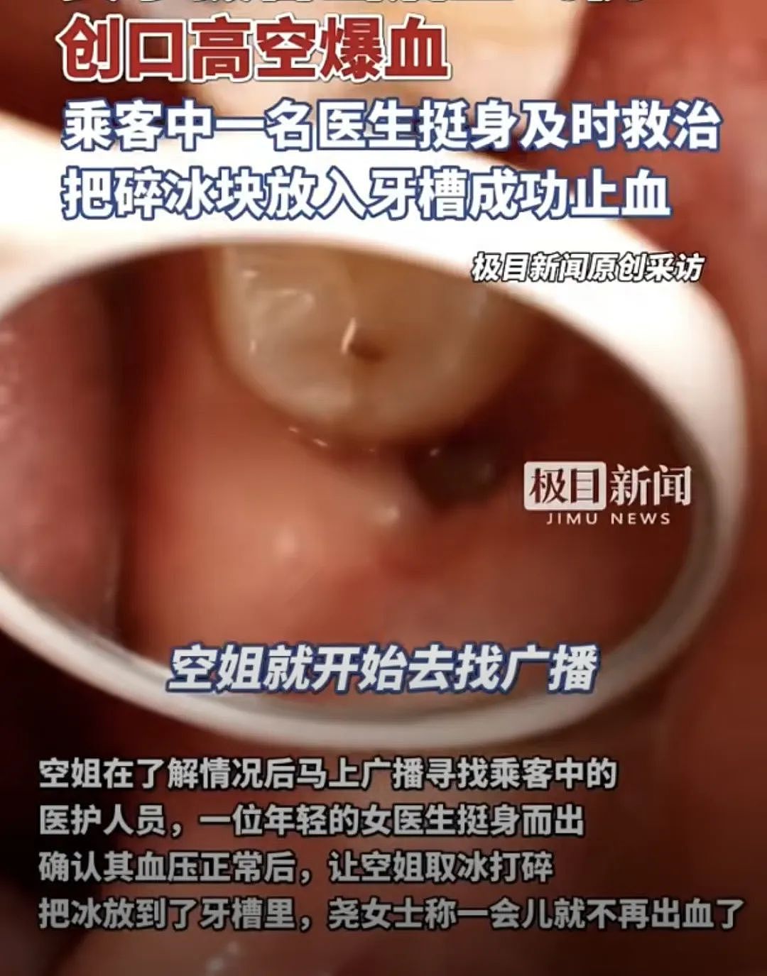 高空惊魂！女子坐飞机嘴里突然开始冒鲜血，医生紧急提醒（视频/组图） - 2