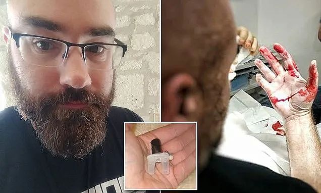 玩大了！西班牙男子给头骨植入了两个角，还因此获得了“超能力“...（组图） - 12