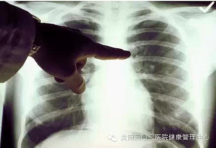 27岁女子查出结节没在意,1年后确诊癌症!医生重要提醒:这一点很关键!赶紧告诉家人(组图) - 1