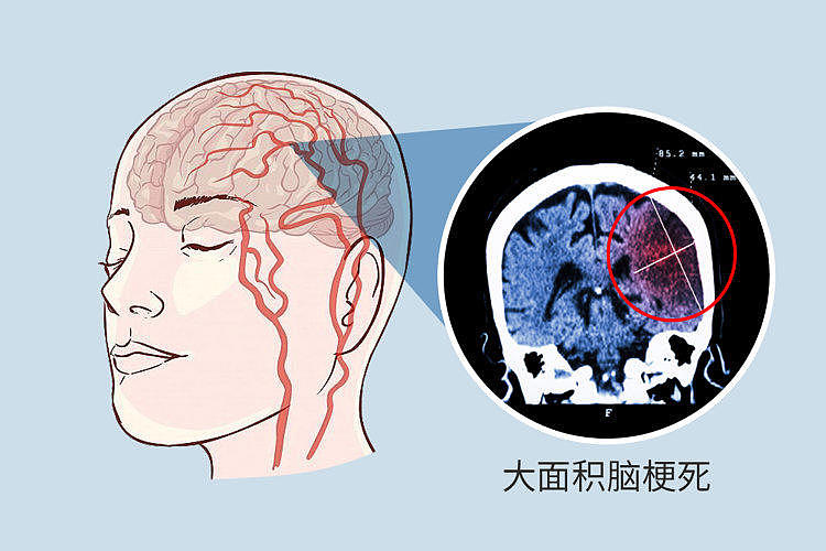 为何中国脑梗死患者越来越多？3种调料是元凶（图） - 1