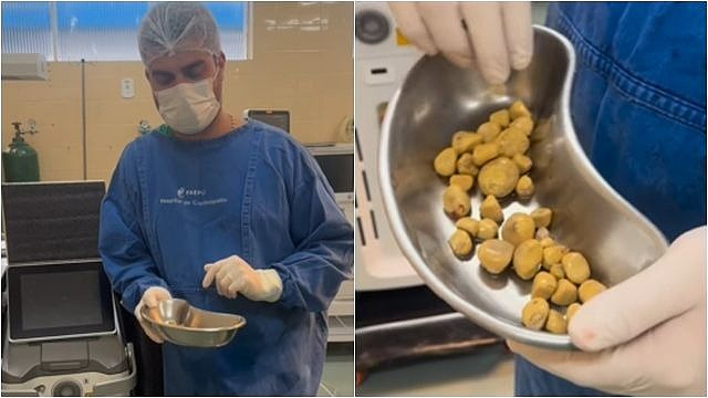 每天狂灌可乐，最后膀胱长满35颗巨石（图) - 1