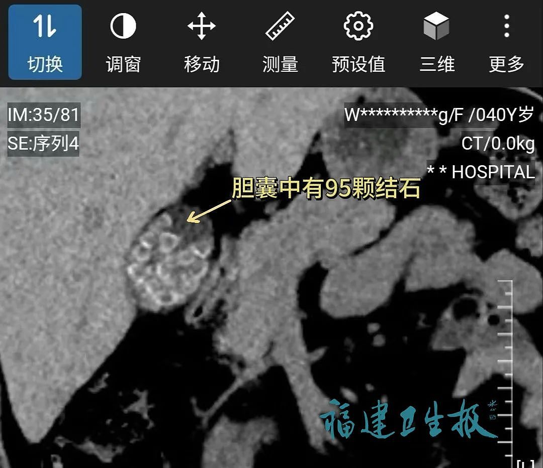 密密麻麻！女子体内塞满近百颗，医生震惊：太危险了！这习惯很多人都有（组图） - 1