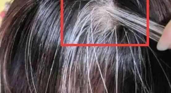 【涨知识】白发长在哪,病就在哪出?长在前额、两鬓、后脑勺,分别代表什么(图) - 1