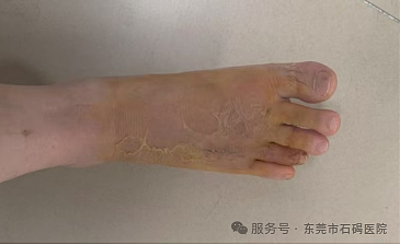 在沙发上睡了一觉，男子差点截趾！严重或危及生命，近期千万当心（组图） - 4