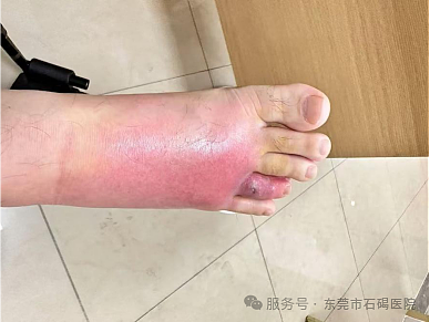 在沙发上睡了一觉，男子差点截趾！严重或危及生命，近期千万当心（组图） - 1