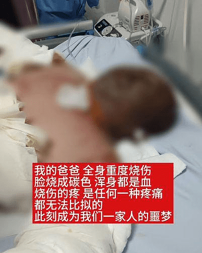 沈阳27岁美妆网红一家三口烧伤毁容，拍康复片被质疑搏同情（组图） - 6