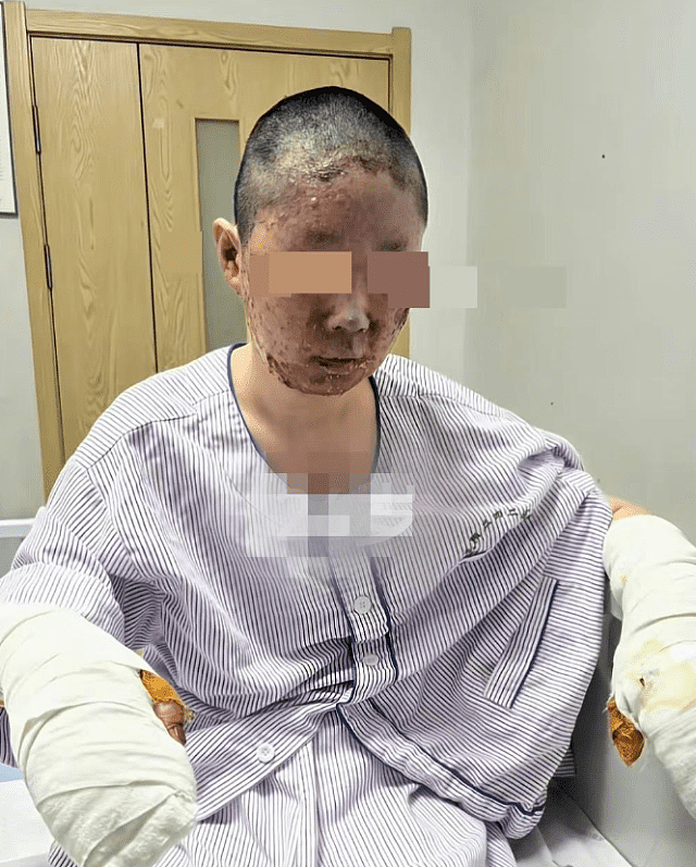 沈阳27岁美妆网红一家三口烧伤毁容，拍康复片被质疑搏同情（组图） - 3