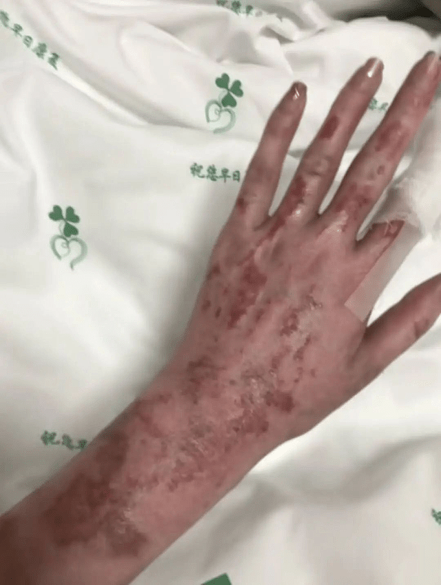 沈阳27岁美妆网红一家三口烧伤毁容，拍康复片被质疑搏同情（组图） - 2