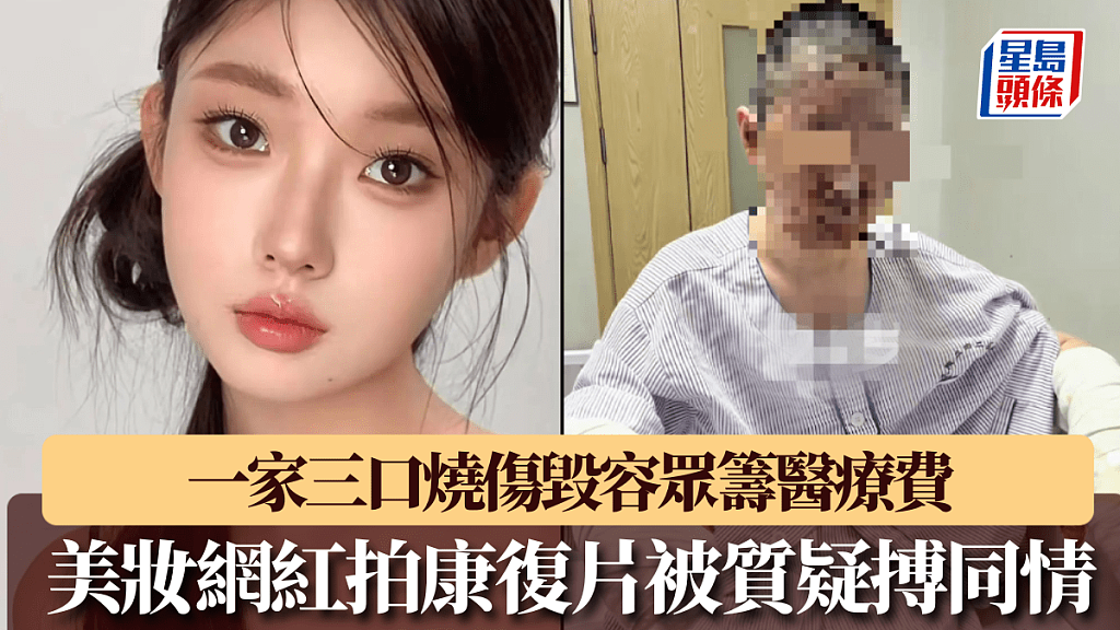 沈阳27岁美妆网红一家三口烧伤毁容，拍康复片被质疑搏同情（组图） - 1