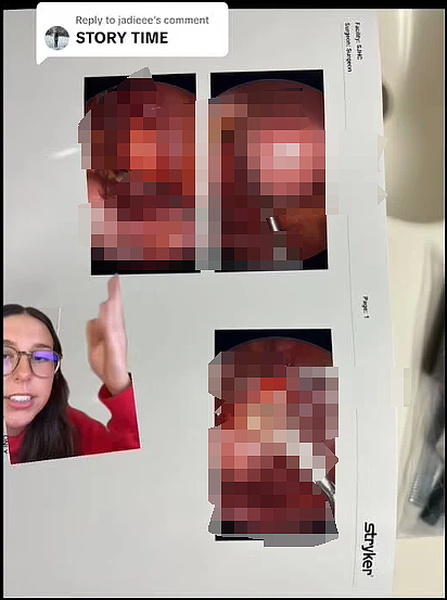 惊悚！美国女大学生怀“怪胎”18年？有牙有眼有头发，吸人养分存活还越长越大（组图） - 10